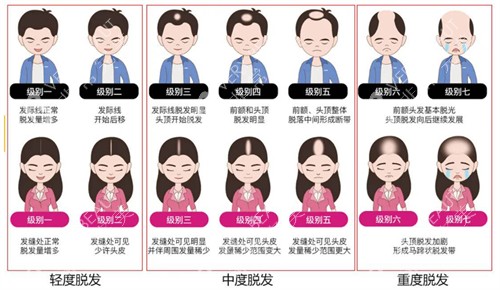 不同程度的脂溢性脫發(fā)