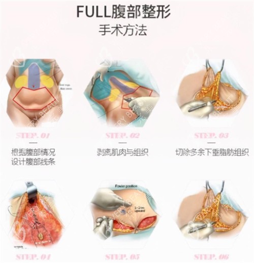 腹壁成形術(shù)手術(shù)過程圖解