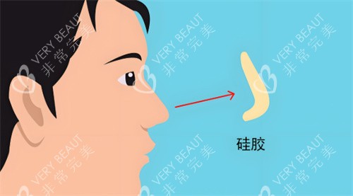 硅膠假體隆鼻