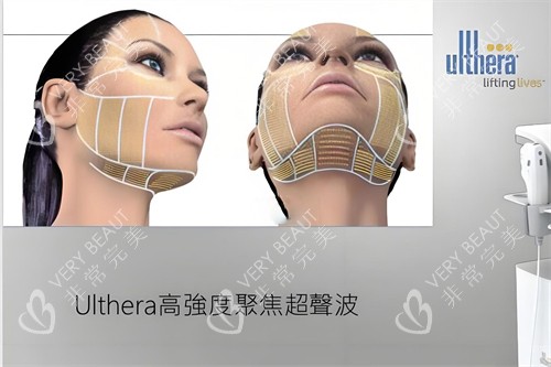 ulthera超聲波