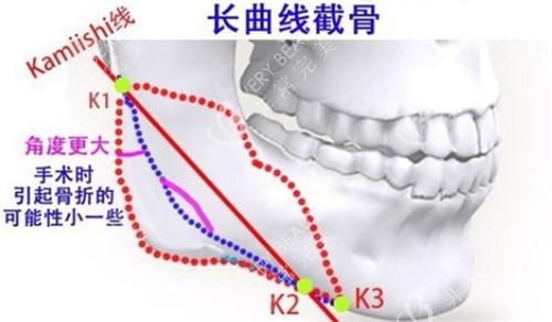 下颌角长曲线截骨的截骨位置