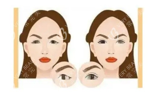 雙眼皮術(shù)前術(shù)后對(duì)比圖