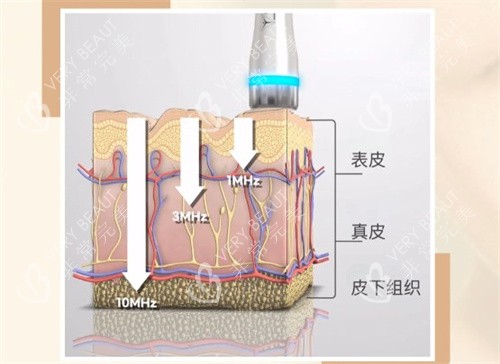 LDM水滴提升是什么