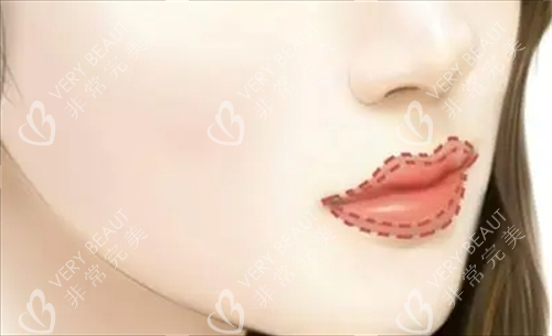 丰唇唇部画线填充图
