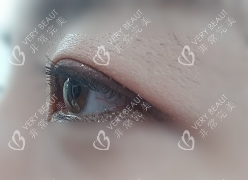 眼皮下垂