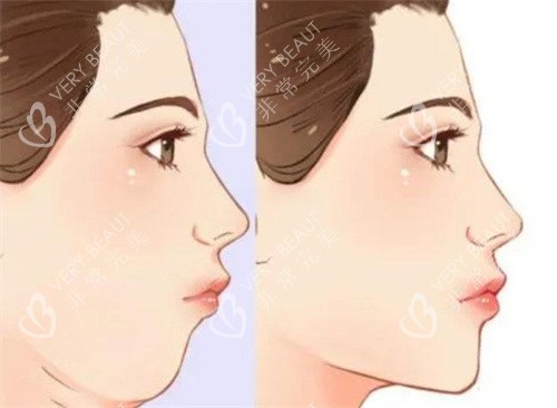 雙下巴抽脂前后對(duì)比側(cè)面動(dòng)畫(huà)圖