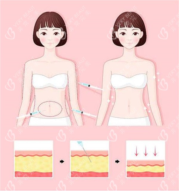 腰腹吸脂对比