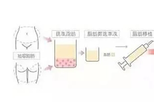 脂肪填充過程示意圖