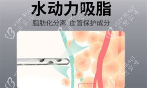 水動(dòng)力吸脂