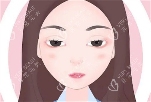 上眼睑下垂1
