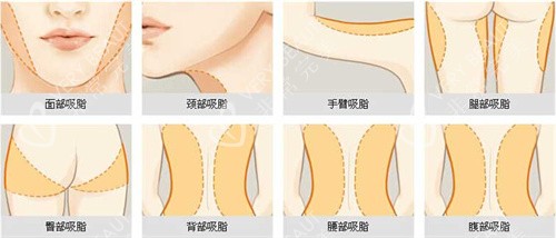可以進(jìn)行吸脂手術(shù)的部位展示動畫圖