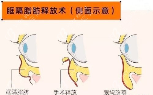 上海张晋宝眶隔脂肪祛眼袋