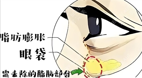 脂肪膨脹性眼袋需要去除的部分