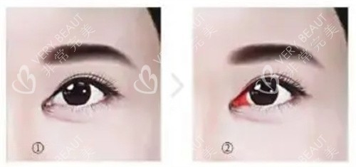需要修復(fù)的內(nèi)眼角