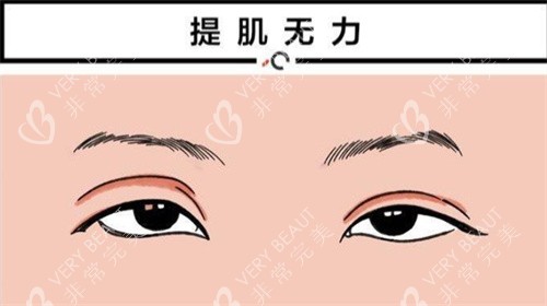 提肌無力