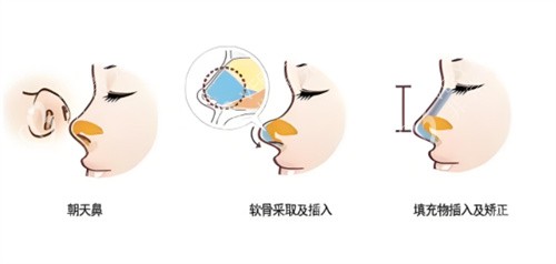朝天鼻矫正术过程