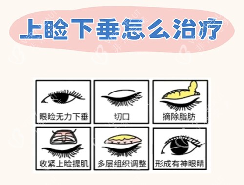 什么是上瞼下垂_怎么治療_2_眼整形陳遠(yuǎn)琨_來自小紅書網(wǎng)頁版