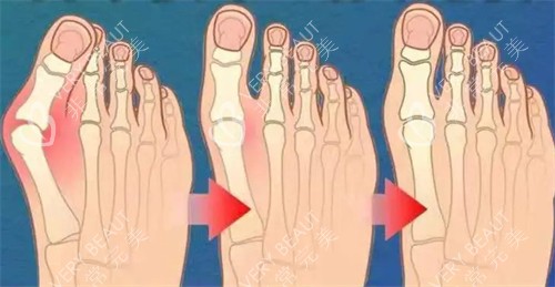 不同程度的大腳骨