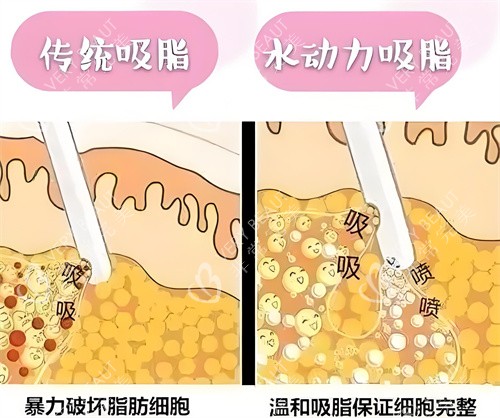 負(fù)壓吸脂和水動力吸脂方式對比動畫圖