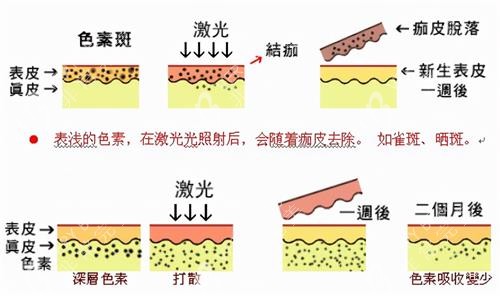 激光祛斑后的變化