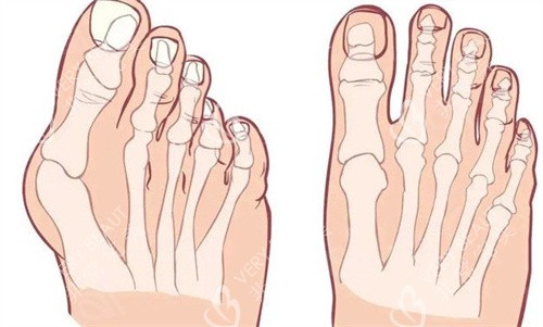 大腳骨的腳和正常對比