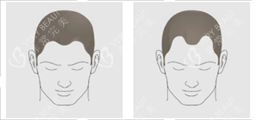 發(fā)際線對(duì)比