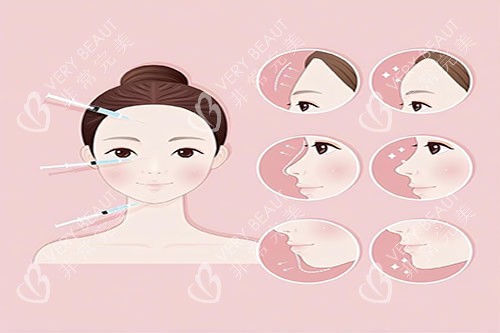 面部玻尿酸注射對(duì)比圖
