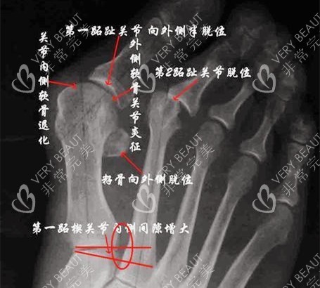 大脚骨X光片