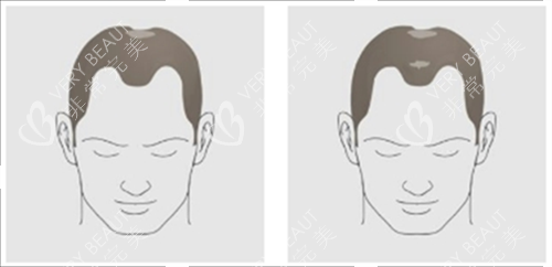 發(fā)際線及頭頂頭發(fā)脫落素材
