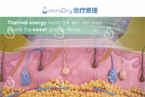 miraDry清新微波治疗原理