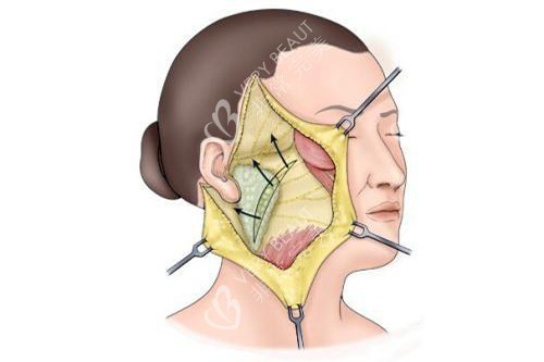 發(fā)際耳后切口拉皮手術(shù)示意圖