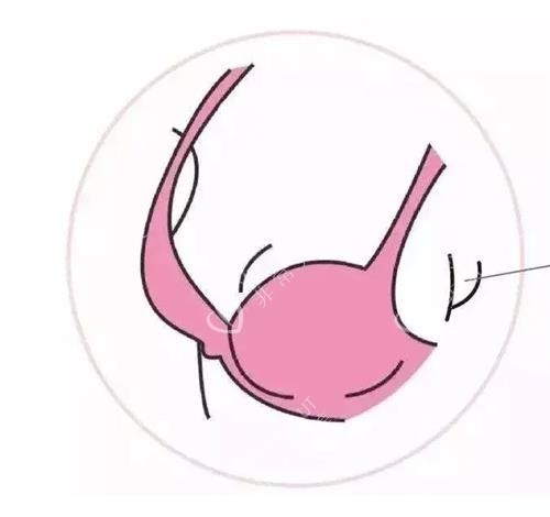副乳示意图