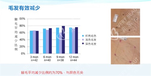 miraDry清新微波结果