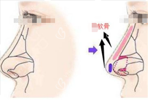 鼻小柱墊軟骨側(cè)面透視圖