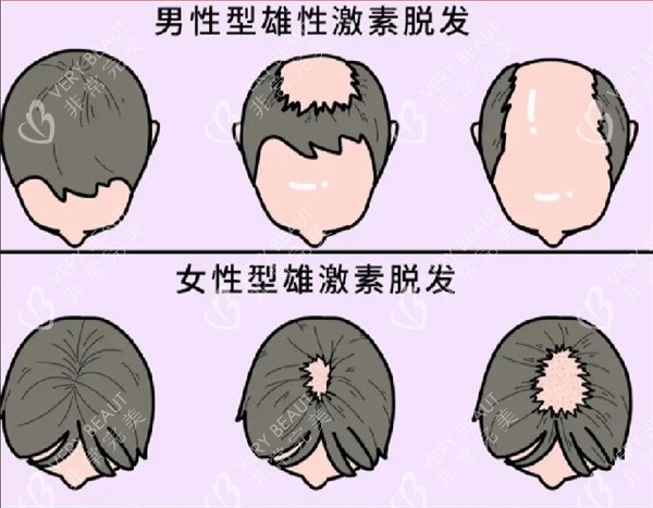 脱发图片