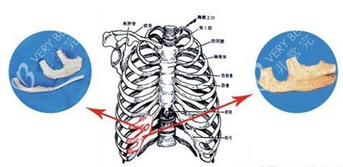 耳再造手术自体肋软骨