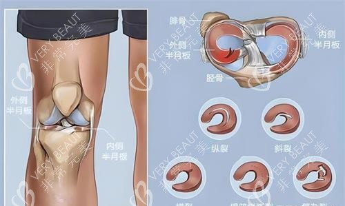 膝盖损伤示意图