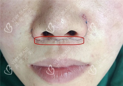 記錄我做人中縮短手術(shù)過程，手術(shù)不疼術(shù)后生活方便比想象中好很多！