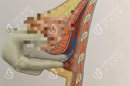 假體隆胸手術(shù)卡通示意圖