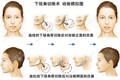 下颌角切除术动画模拟图