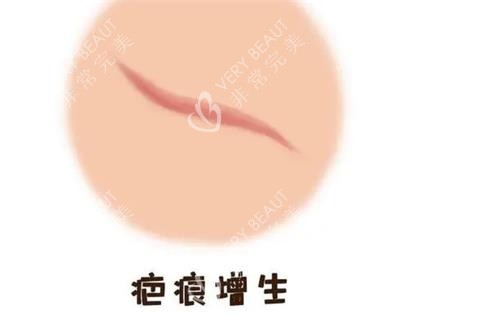 疤痕增生图示