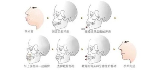 正頜手術(shù)步驟圖示