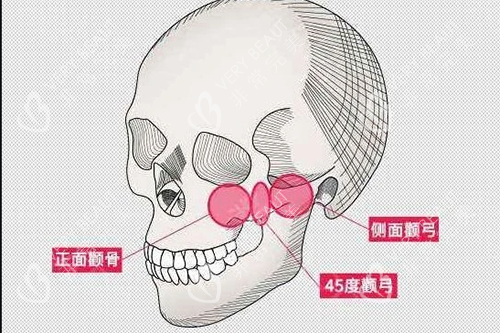 颧骨颧弓大概位置示意图