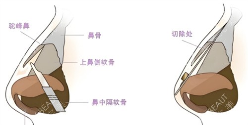 驼峰鼻矫正鼻部组织图