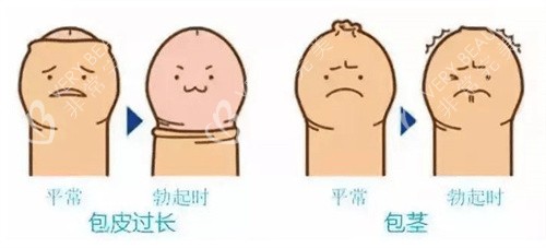 包皮过长和包茎