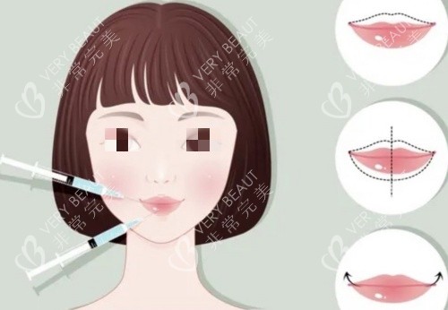 丰唇注射前后示意图