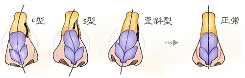 歪鼻矫正类型