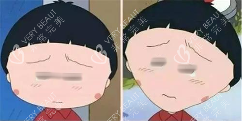 打针瘦脸前后明显对比图