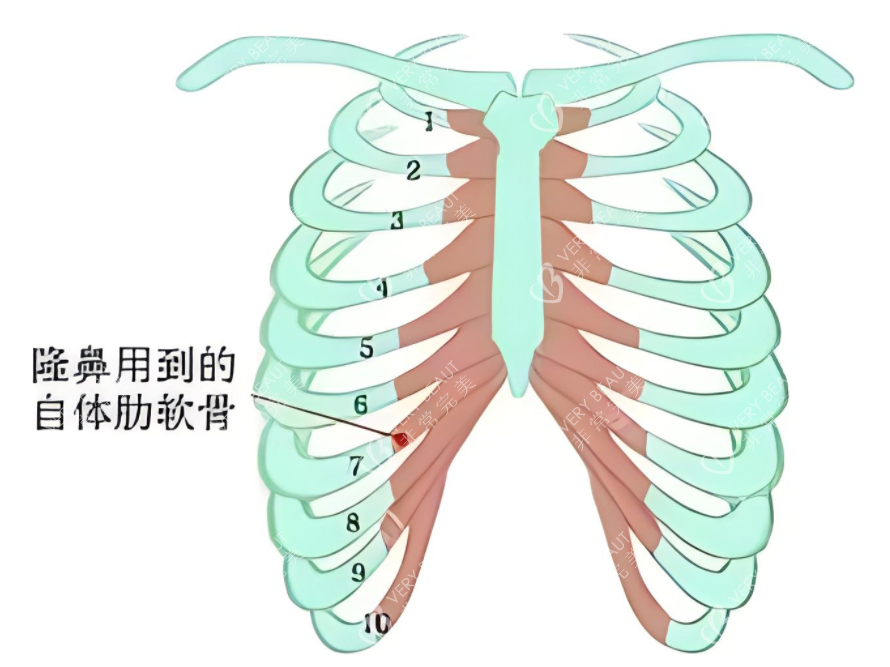 隆鼻肋骨鼻所用肋骨