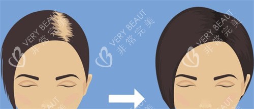 植发前后对比示图